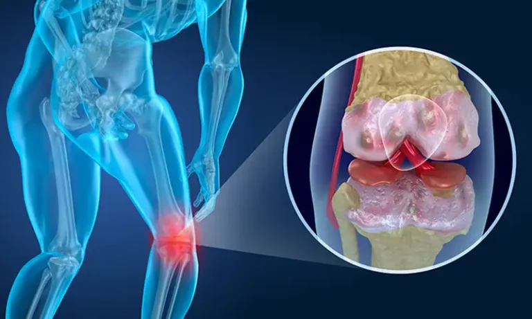 Biomagnetism-Arthrities