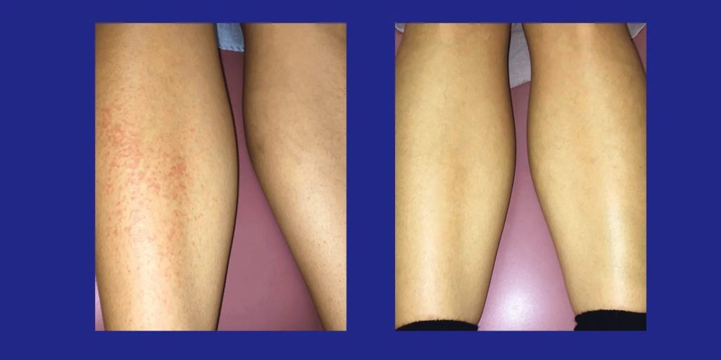 measles-on-the-legs-blog